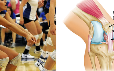 What You Need to Know About Patellar Tendinitis